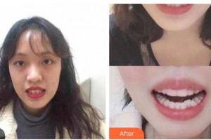 樂(lè)山口腔醫(yī)院龐洪整形價(jià)格表附牙齒隱形矯正案例展示