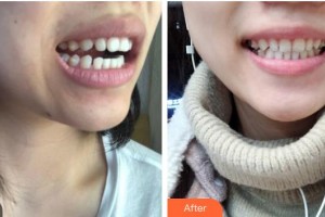 樂(lè)山口腔醫(yī)院張麗梅整形價(jià)格表附牙齒隱形矯正案例展示