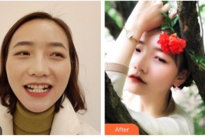 樂(lè)山口腔醫(yī)院何肖倩整形價(jià)格表附牙齒隱形矯正案例展示