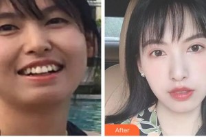 樂(lè)山口腔醫(yī)院魏寧整形價(jià)格表附金屬托槽矯正案例展示