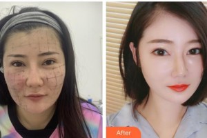 南充新韻悅美醫(yī)療美容門(mén)診部杜娟杜娟整形價(jià)格表附熱瑪吉案例展示