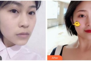 南充中心醫(yī)院整形美容外科徐海整形價(jià)格表附埋線提升案例展示