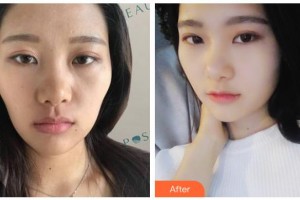 南充中心醫(yī)院整形美容外科雷英整形價(jià)格表附熱瑪吉案例展示