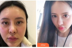 南充阿藍(lán)醫(yī)療美容門(mén)診部傅崇華整形價(jià)格表附埋線提升案例展示