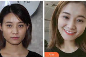 南充阿藍(lán)醫(yī)療美容門(mén)診部雷曉東整形價(jià)格表附埋線提升案例展示