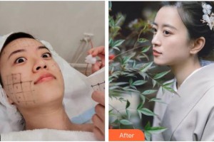 南充阿藍(lán)醫(yī)療美容門(mén)診部沙新力整形價(jià)格表附熱瑪吉案例展示