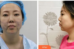 南充阿藍(lán)醫(yī)療美容門(mén)診部李仁華整形價(jià)格表附埋線提升案例展示