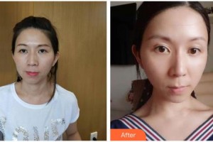 南充阿藍(lán)醫(yī)療美容門(mén)診部常明整形價(jià)格表附熱拉提案例展示