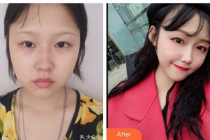 南充阿藍(lán)醫(yī)療美容門(mén)診部賀怡整形價(jià)格表附埋線提升案例展示