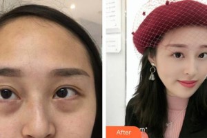 南充醫(yī)美整形外科診所袁學(xué)江整形價(jià)格表附內(nèi)切祛眼袋案例展示