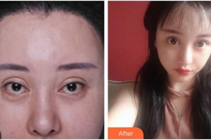 南充嬌美傾城醫(yī)學(xué)美容門(mén)診部劉娟整形價(jià)格表附眼部修復(fù)案例展示