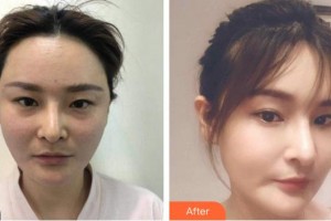 南充新韻悅美醫(yī)療美容門(mén)診部鄧志文整形價(jià)格表附埋線提升案例展示