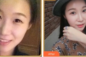 南充韓美整形美容門(mén)診部陳斌整形價(jià)格表附熱瑪吉案例展示