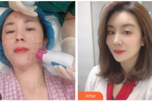 南充新韻悅美醫(yī)療美容門(mén)診部付崇華整形價(jià)格表附熱瑪吉案例展示