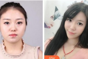 南充韓美整形美容門(mén)診部龔承安整形價(jià)格表附埋線提升案例展示