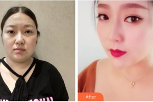 南充新韻悅美醫(yī)療美容門(mén)診部何秀整形價(jià)格表附埋線提升案例展示