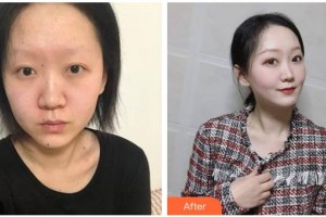 南充五星美容整形門(mén)診部劉隆澤整形價(jià)格表附埋線提升案列展示