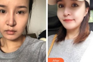 南充五星美容整形門(mén)診部劉漢儒整形價(jià)格表附埋線提升案例展示