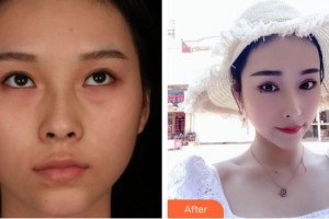 南充五星美容整形門(mén)診部劉新一整形價(jià)格表附切開(kāi)雙眼皮案例展示