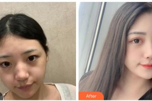 南充韓美整形美容門(mén)診部陳慶紅整形價(jià)格表附激光祛斑案例展示