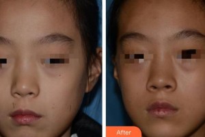 南充韓美整形美容門(mén)診部鄧麗華整形價(jià)格表附激光點(diǎn)痣案例展示