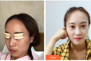南充華美名媛整形美容醫(yī)院彭旦生整形價(jià)格表附切開雙眼皮案例展示