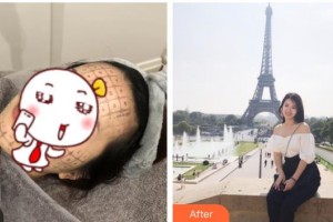 南充嬌美傾城醫(yī)學(xué)美容門(mén)診部余劍雄整形價(jià)格表附熱瑪吉案例展示