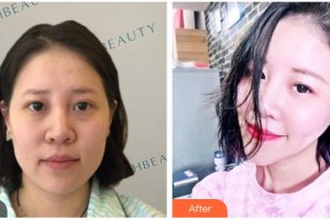 南充嬌美傾城醫(yī)學(xué)美容門診部曾飛整形價(jià)格表附熱瑪吉案例展示