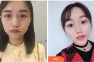 南充阿藍(lán)醫(yī)療美容門(mén)診部整形價(jià)格表附熱瑪吉案例展示