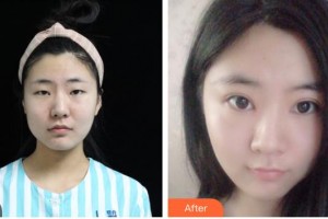 南充圣仁安名仁眼科醫(yī)院廖瓊整形價(jià)格表附切開(kāi)雙眼皮案例展示