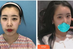 南充愛(ài)爾麥格眼科醫(yī)院冉海軍整形價(jià)格表附眼部綜合案例展示