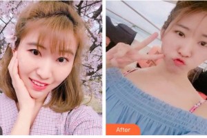 南充潤(rùn)禾皮膚病?？漆t(yī)院趙成均住院醫(yī)師整形價(jià)格表附切開(kāi)雙眼皮案例展示