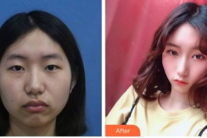 南充潤(rùn)禾皮膚病?？漆t(yī)院萬(wàn)年整形價(jià)格表附上瞼提肌案例展示