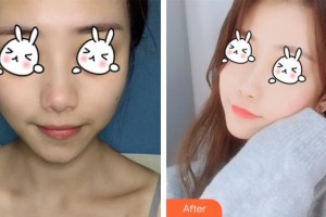 南充潤(rùn)禾皮膚病?？漆t(yī)院邱坤整形價(jià)格表附光子嫩膚案例展示