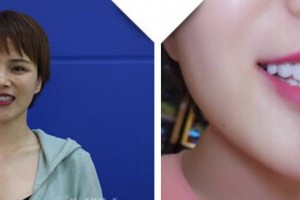 南充遠(yuǎn)大口腔門(mén)診部王云玲整形價(jià)格表附牙貼面案例展示