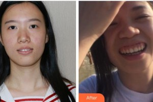 南充德美牙科診所明華偉整形價(jià)格表附隱形托槽矯正案例展示