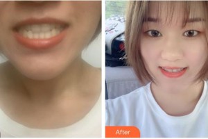 南充美佳口腔診所王永武整形價(jià)格表附牙齒隱形矯正案例展示