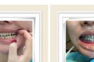 南充美佳口腔診所何成柏整形價(jià)格表附金屬托槽矯正案例展示