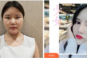 眉山華信醫(yī)學(xué)整形美容醫(yī)院李健剛整形價(jià)格表附切開雙眼皮案例展示