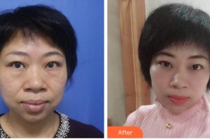 眉山華信醫(yī)學(xué)整形美容醫(yī)院溫樹森整形價(jià)格表附激光去眼袋案例展示