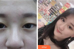 眉山市人民醫(yī)院醫(yī)學(xué)美容科張玉瓊整形價(jià)格表附定點(diǎn)雙眼皮案例展示