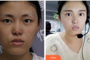 眉山市人民醫(yī)院醫(yī)學(xué)美容科曾藍(lán)瑤整形價(jià)格表附定點(diǎn)雙眼皮案例展示