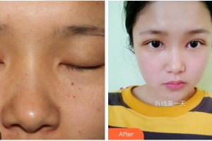 眉山天使醫(yī)療美容整形醫(yī)院倪俊整形價(jià)格表附切開雙眼皮案例展示