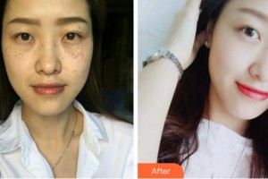 眉山皮膚病醫(yī)院皮膚美容科鄭雪蕾整形價(jià)格表附鐳射凈膚案例展示