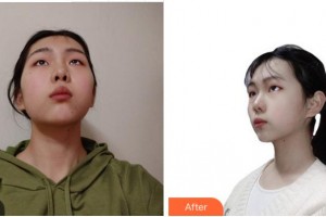 眉山悅美醫(yī)療美容門診部衡敏整形價(jià)格表附光子嫩膚案例展示