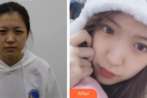 眉山市中醫(yī)院眼科馮馳整形價(jià)格表附眼部綜合案例展示