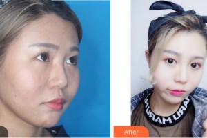 眉山市中醫(yī)院眼科謝啟龍整形價(jià)格表附激光去眼袋案例展示