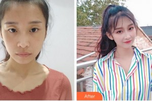 峨眉山市人民醫(yī)院眼科李秀倫整形價(jià)格表附切開雙眼皮案例展示