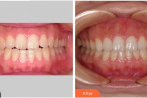 眉山黃記口腔診所陳麒羽整形價(jià)格表附隱形托槽矯正案例展示