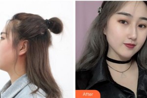 宜賓宜美醫(yī)學(xué)美容診所詹清整形價(jià)格表附鼻骨矯正案例展示